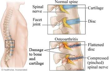 osteoarthritis-information_orig